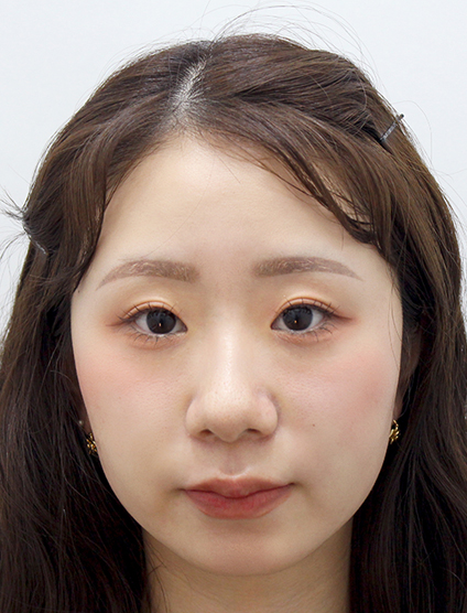 ほうれい線のヒアルロン酸注入