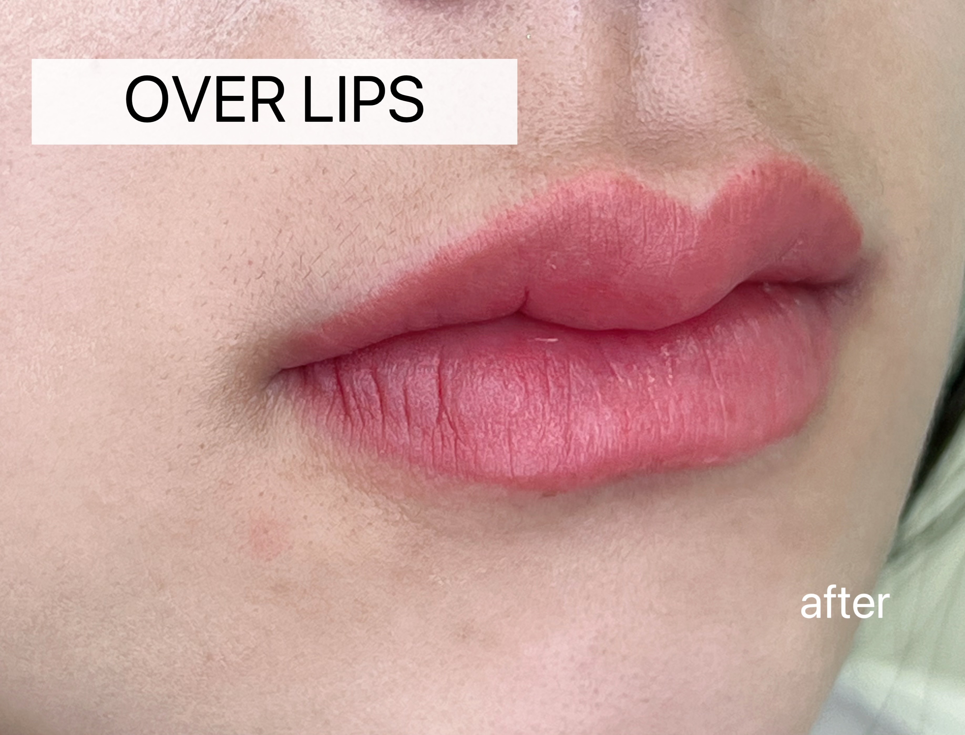 雾唇 — 加宽唇形(Over-lip)