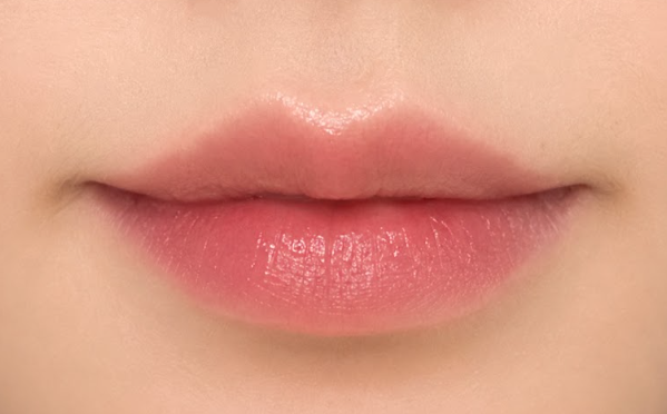 Lip Filler Before & After