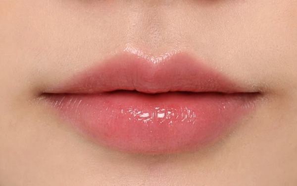 Lip Filler Before & After