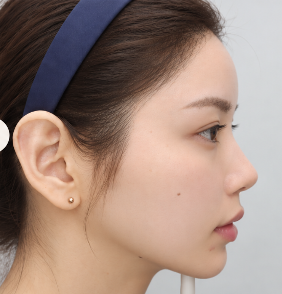Forehead Filler Before & After